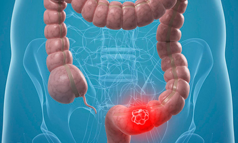 Πότε να κάνεις εξετάσεις για να αποφύγεις τον καρκίνο παχέος εντέρου;