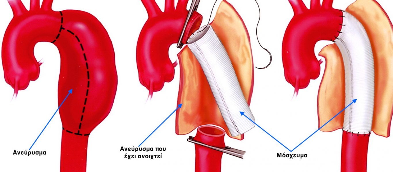 Ανεύρυσμα κοιλιακής αορτής: Όλα όσα πρέπει να γνωρίζετε
