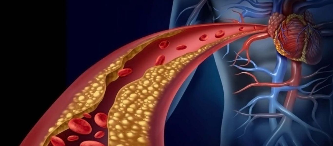 Όλα όσα πρέπει να ξέρετε για την στεφανιαία νόσο – Συμπτώματα & θεραπεία