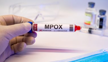 Νέος θάνατος από τον ιό mpox στη Νότια Αφρική – Πώς μεταδίδεται