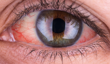 Κόκκινα μάτια: Δείτε ποιες είναι οι 15 πιο συνηθισμένες αιτίες