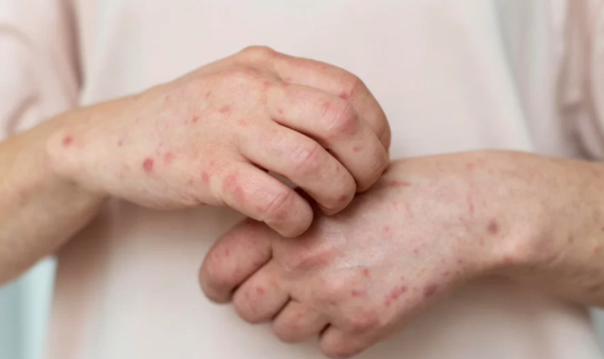 Αλλεργικό σοκ: Έτοιμη για έγκριση η πρώτη αδρεναλίνη που λαμβάνεται με εισπνοή και όχι με ένεση