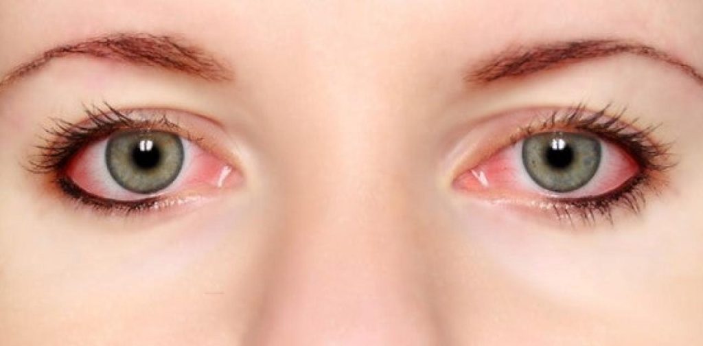 Όσα πρέπει να ξέρετε για τα κόκκινα μάτια – Οι πιθανές αιτίες και οι φυσικοί τρόποι αντιμετώπισης