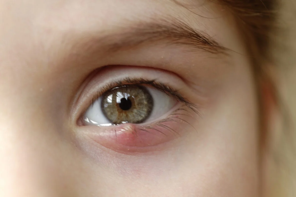 Κριθαράκι στο μάτι: Με αυτούς τους 9 τρόπους θα απαλλαγείτε άμεσα